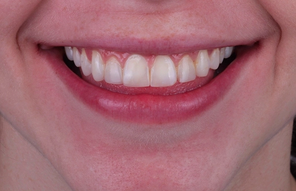 Antes del tratamiento 1