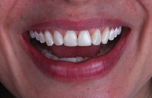 Antes del tratamiento 3