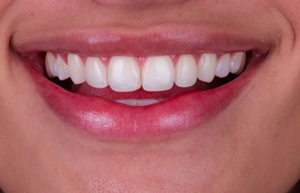 Antes del tratamiento 3