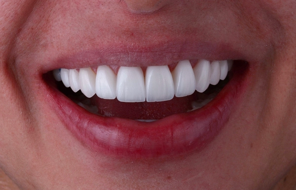 Después del tratamiento 3