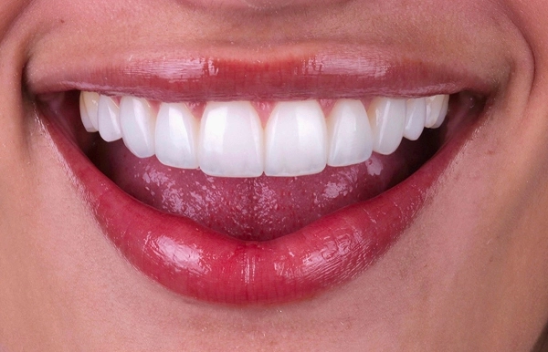 Después del tratamiento 3