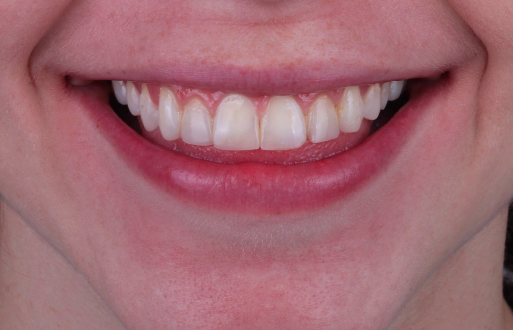 Antes del tratamiento 1