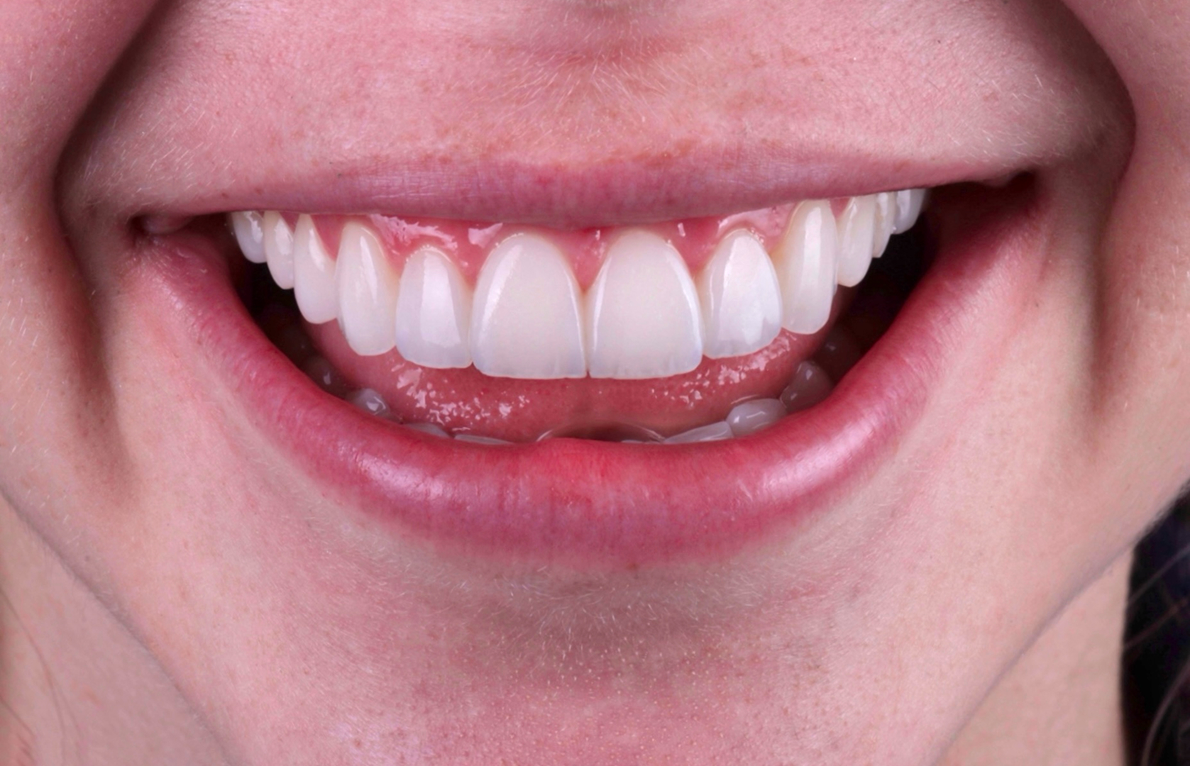 Después del tratamiento 1