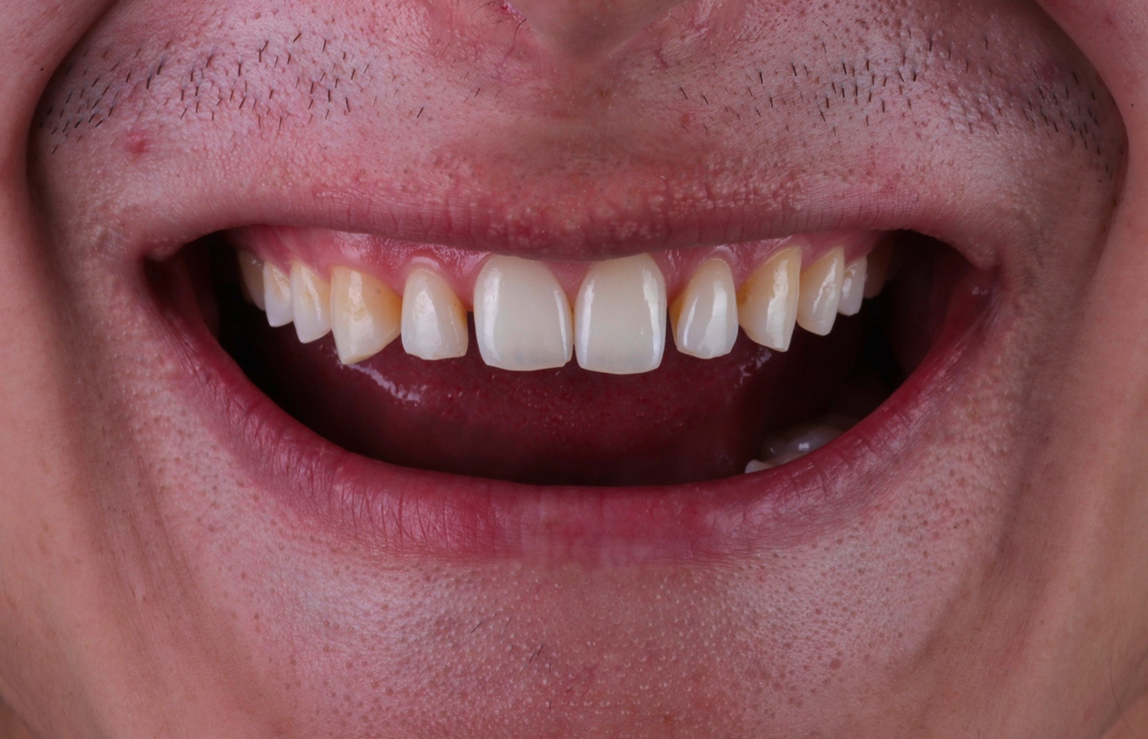 Antes del tratamiento 2