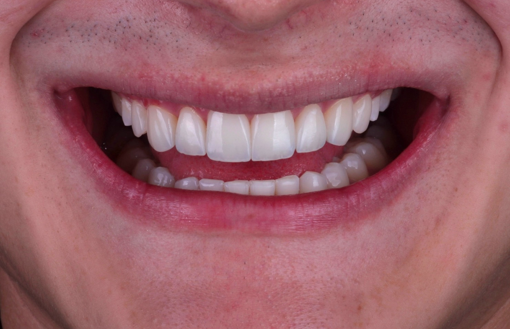 Después del tratamiento 2