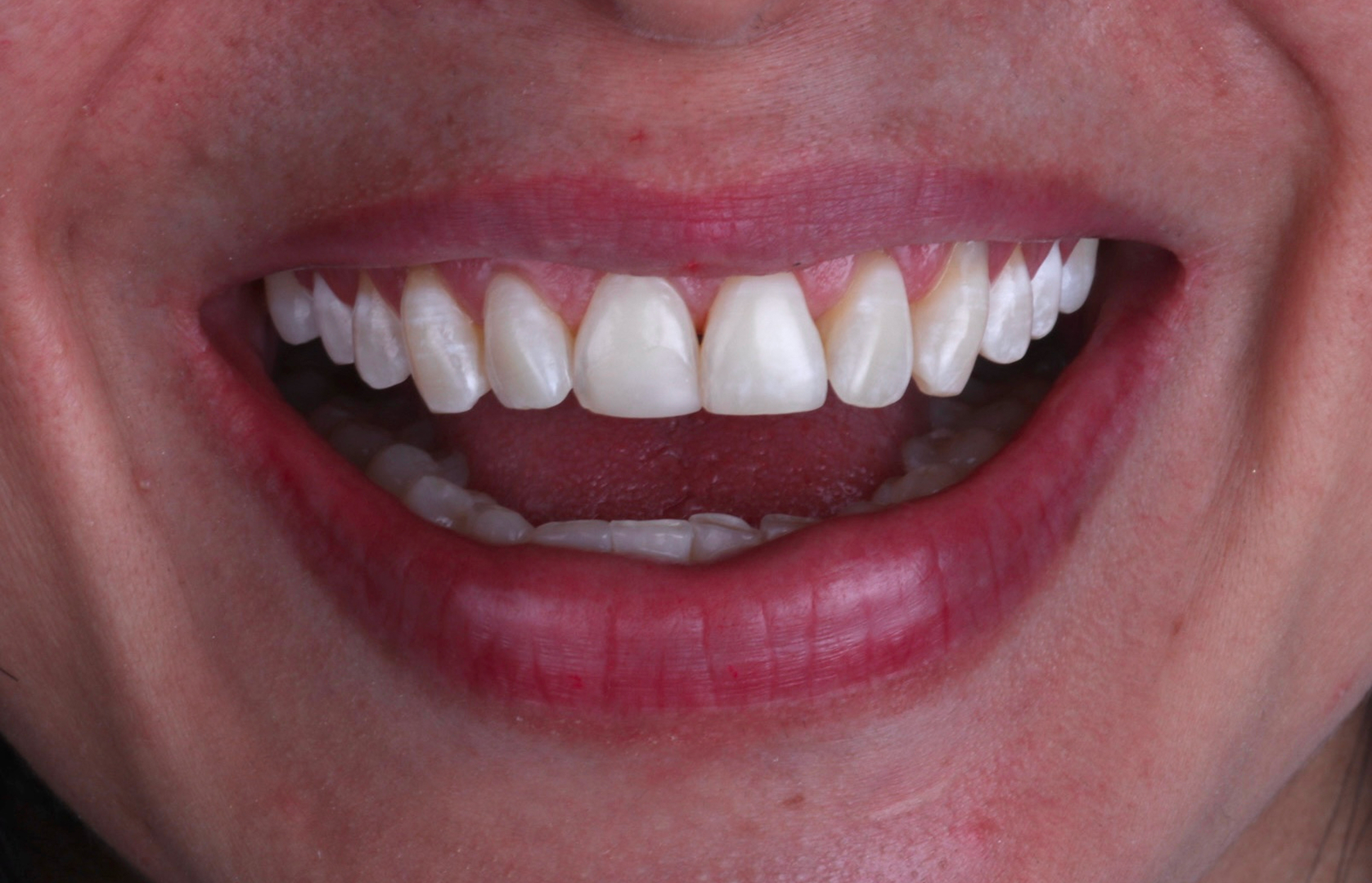 Antes del tratamiento 3