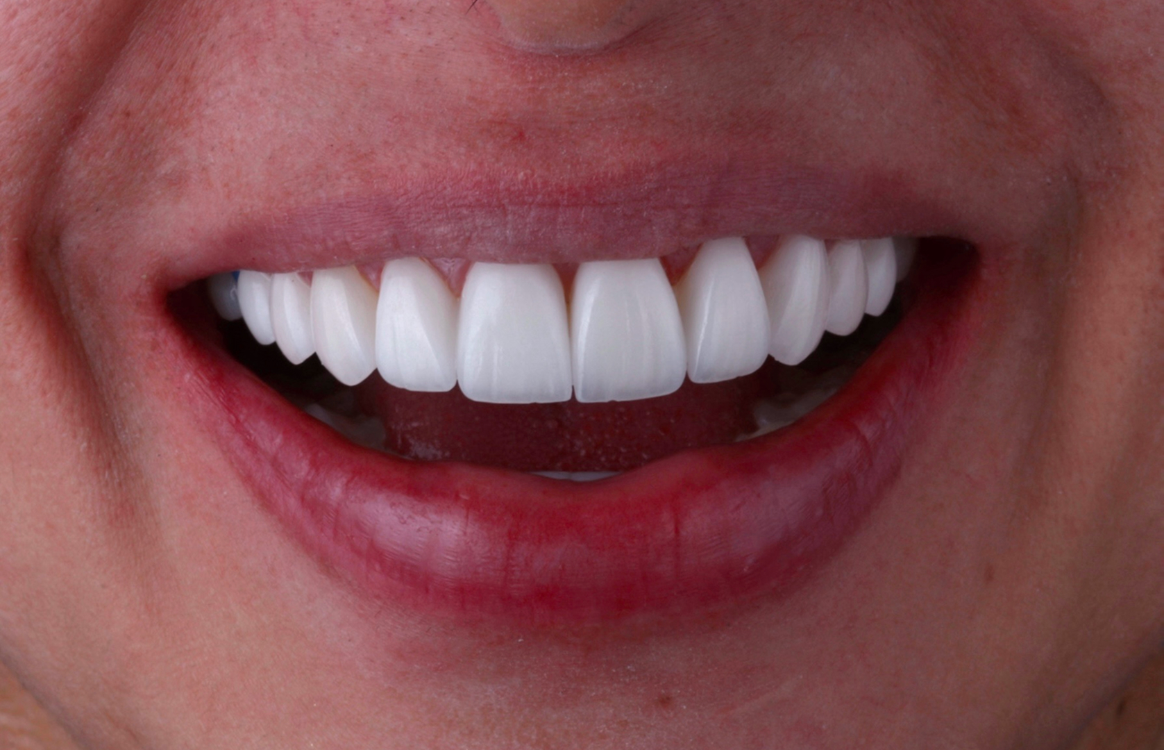 Después del tratamiento 3