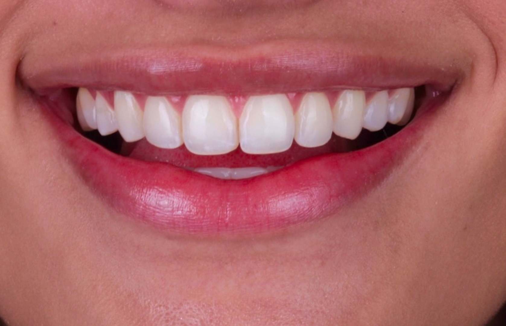 Antes del tratamiento 3