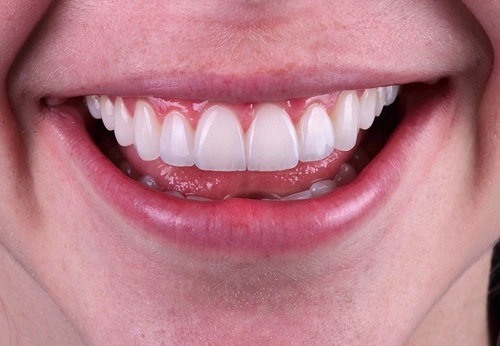 Imagen sobre Estética dental de alta precisión