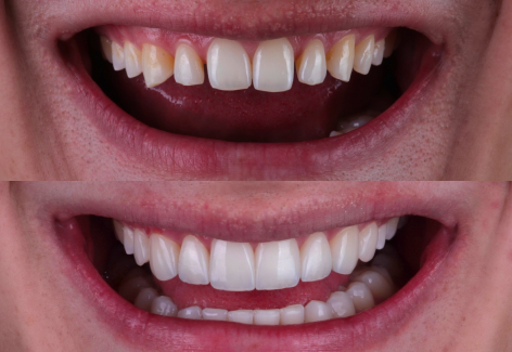 Imagen ilustrativa sobre Estética dental de alta precisión