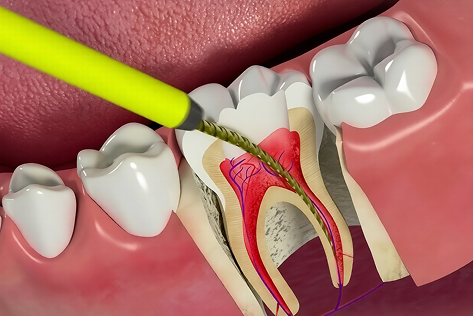 Endodoncia