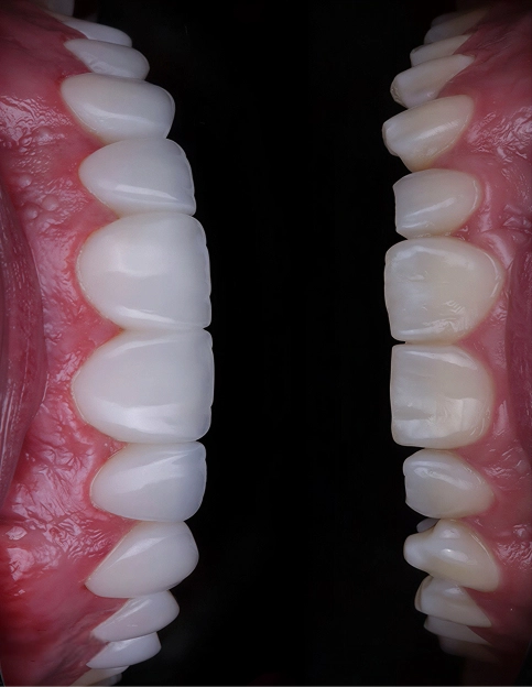 ¿Qué es el diseño de sonrisa?